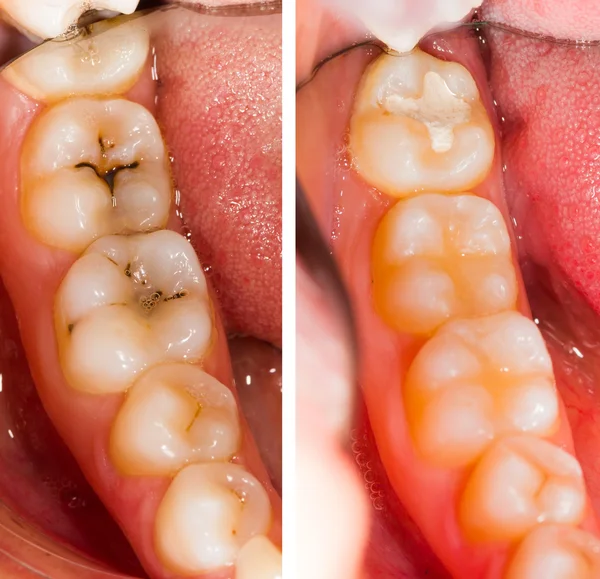 Прежде и после зубного лечения — стоковое фото