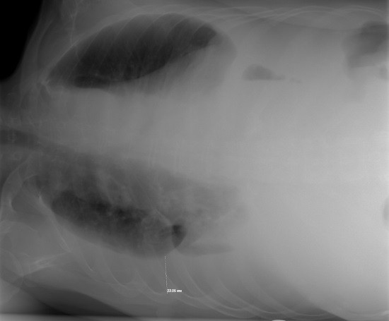 Рентгенограмма в латеропозиции на правом боку