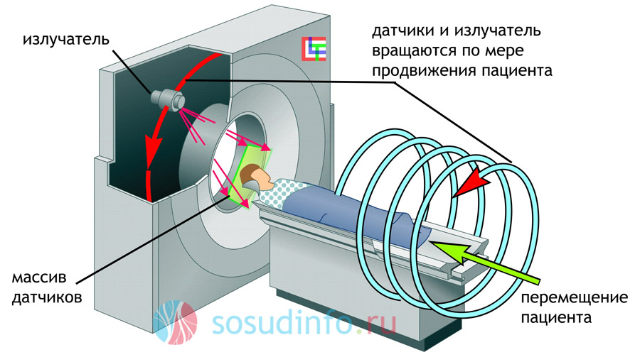 компьютерная томография (КТ)