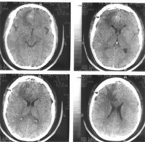 Компьютерная томография головного мозга того же больного через 4 дня после операции — удаления внутримозговой гематомы правой лобной доли