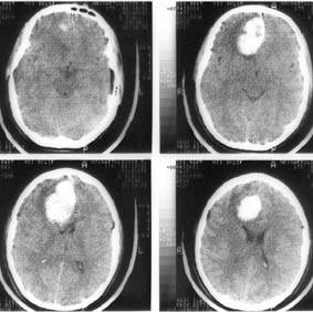 Компьютерная томография головного мозга. Гипертензионная субкортикальная гематома в правой лобной доле