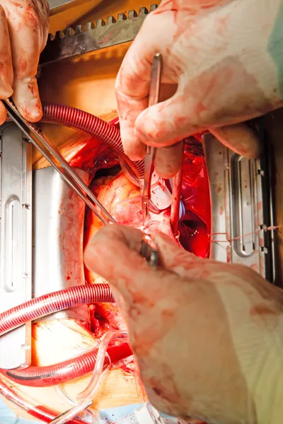 Коронарное шунтирование, операция на сердце — стоковое фото