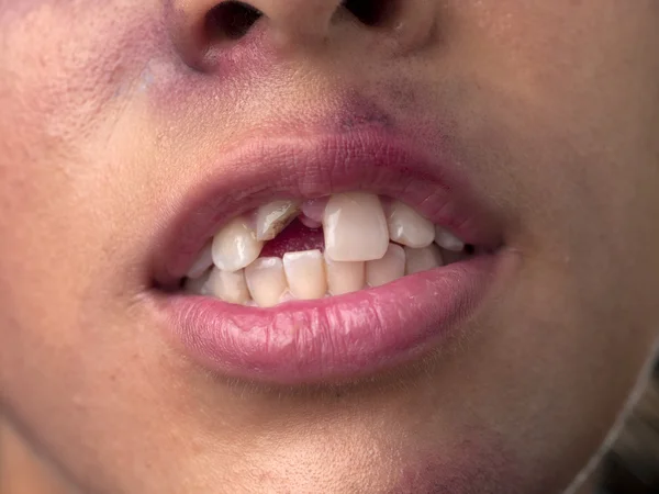 Заделывают женщины с Сломанные зубы — стоковое фото