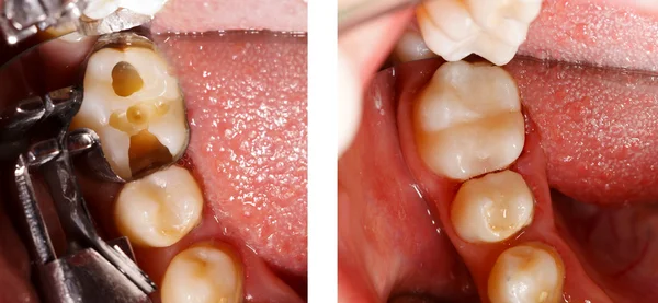 Зуб, заполняющийся дантистом — стоковое фото