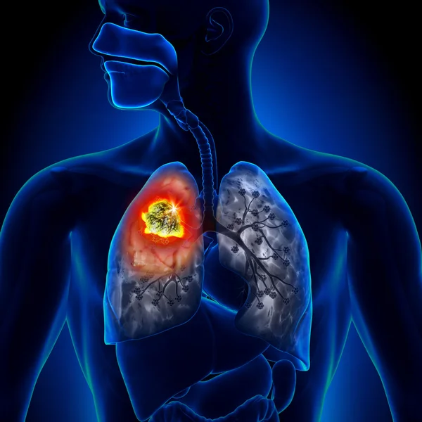 Рак легких - опухоль подробно — стоковое фото