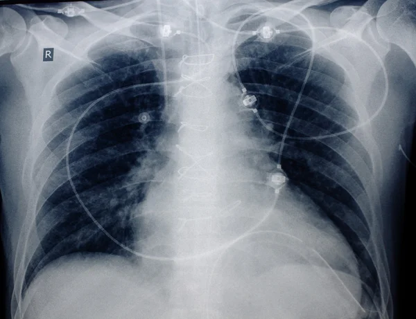 Рентгенограмма грудной клетки пациента после кардиохирургической операции — стоковое фото