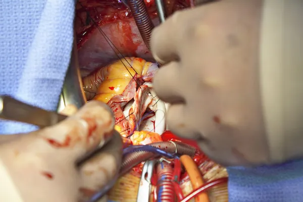 Операция на открытом сердце. Пластиковые митрального клапана — стоковое фото