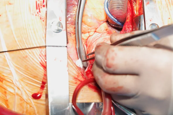 Операции на сердце. операция на открытом сердце. коронарной артерии объездной волноплеск — стоковое фото
