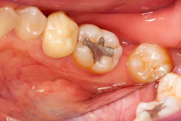 Зубные проблемы — стоковое фото