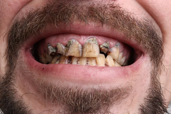 Плохие зубы курильщика больных — стоковое фото