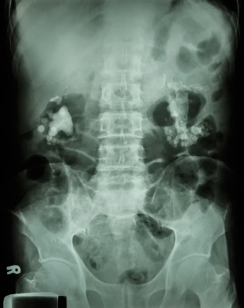 Bilateral renal calculi(staghorn) Стоковое Фото
