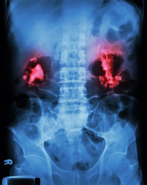 Bilateral renal calculi(staghorn) Стоковое Изображение