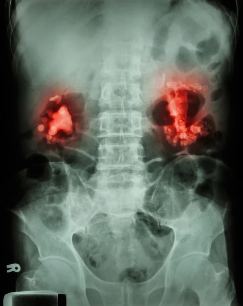 Bilateral renal calculi(staghorn) Лицензионные Стоковые Изображения