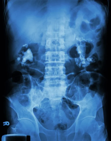 Bilateral renal calculi(staghorn) Лицензионные Стоковые Изображения