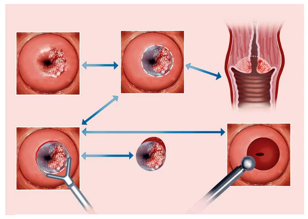 Иллюстрация Который Описывает Процесс Прижигания Пострадавших Рака Шейки Матки — стоковое фото