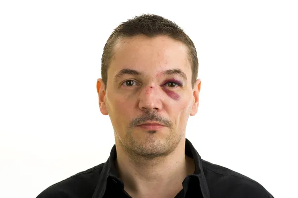 Человек с сломанной, кривым носом и черных глаз — стоковое фото