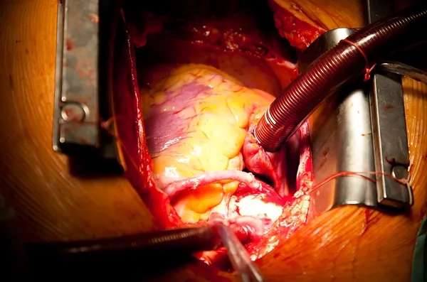 Coronary artery bypass grafting — стоковое фото